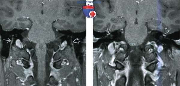 КТ, МРТ при параличе Белла