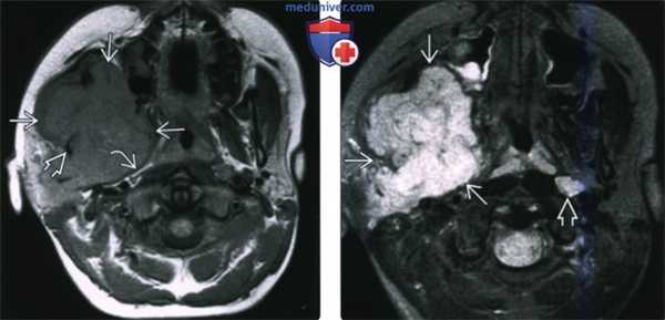 КТ, МРТ при саркоме жевательного пространства