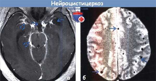 Нейроцистицеркоз на МРТ