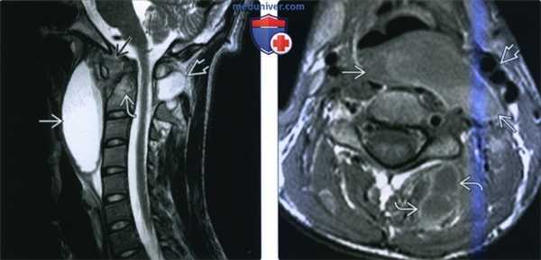 КТ, МРТ при флегмоне паравертебрального пространства