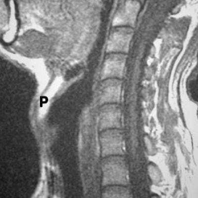 МРТ здоровой гортани