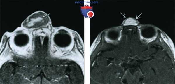 КТ, МРТ при глиоме носа