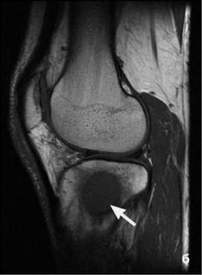 Снимок МРТ при опухолях костей