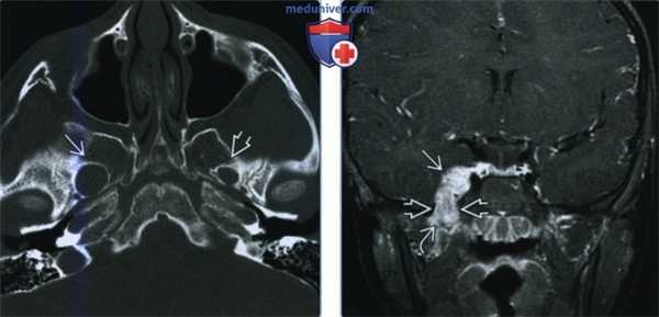 Шваннома жевательного пространства - лучевая диагностика