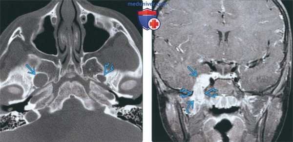 Лучевая диагностика шванномы жевательного пространства