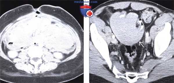 Рентген, КТ, МРТ, УЗИ при десмоидной опухоли (десмоиде)
