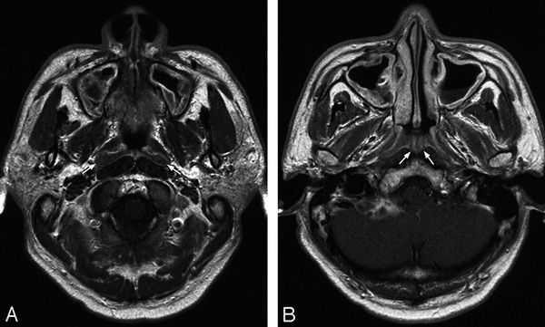 Обзорное обследование околоносовых пазух с использованием мощного магнитного поля