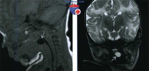 Врожденная киста валлекулы - лучевая диагностика