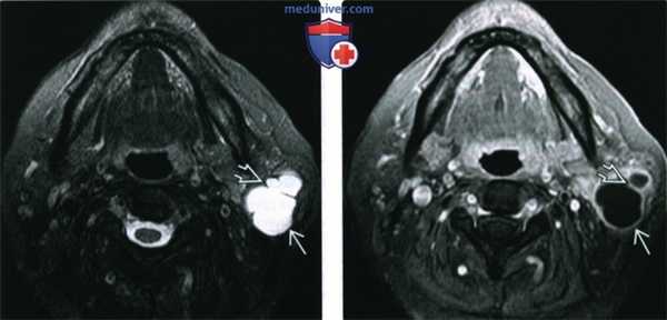 КТ, МРТ при опухоли Вартина
