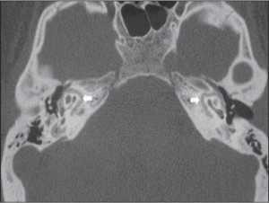 Отосклероз КТ 2