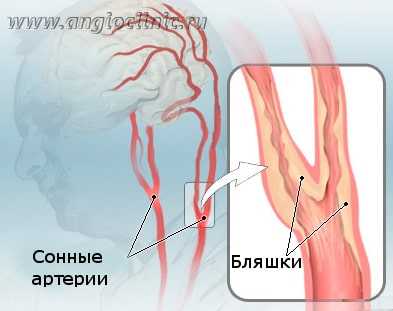 Бляшки в сонных артериях являются самой частой причиной ишемического инсульта