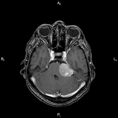Рис.1. Пациент Ж., 58 лет. МСКТ ротоглотки в аксиальной проекции: А - нативное исследование, В - с внутривенным болюсным контрастированием. Небольшая инфильтративная опухоль ротоглотки (левой небной миндалины Т1 стадии). Границы опухоли не дифференцируются, накопление контраста слабое (показатели плотности в нативной фазе исследования 45 ед.Н, после внутривенного болюсного усиления - 56 ед.Н). Определяется смещение левой стенки ротоглотки, сглаженность контура (стрелки)