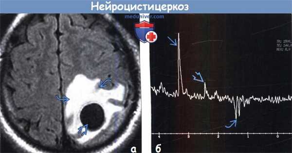 Нейроцистицеркоз на МРТ