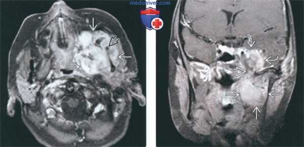 КТ, МРТ при саркоме жевательного пространства