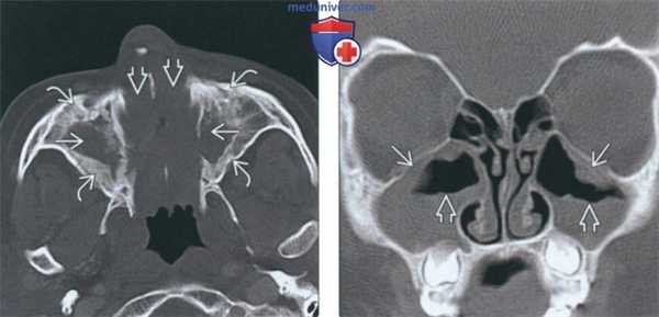 КТ, МРТ при хроническом риносинусите