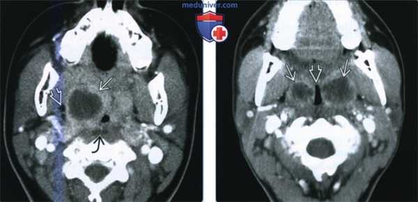 Миндаликовый и паратонзиллярный абсцесс - лучевая диагностика