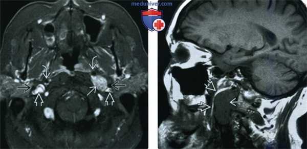 КТ, МРТ при вагальной параганглиоме