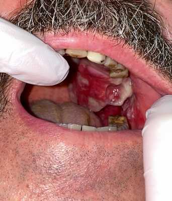 Остеогенная саркома альвеолярного отростка верхней челюсти