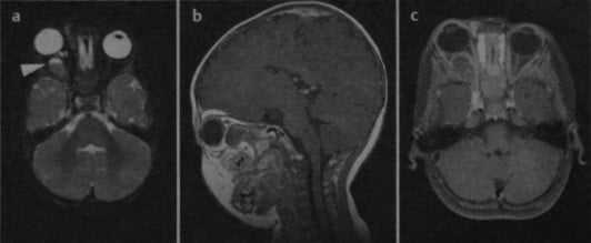 Снимки МРТ и КТ. Гемангиома глазницы