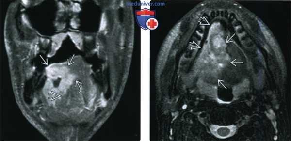 КТ, МРТ при плоскоклеточном раке тела и верхушки языка