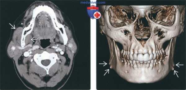 Лучевая диагностика доброкачественной гипертрофии жевательных мышц