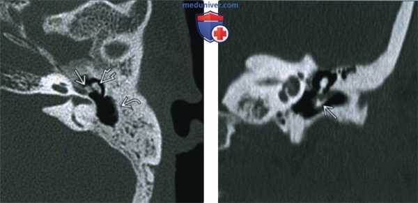 Хронический отомастоидит с тимпаносклерозом - лучевая диагностика
