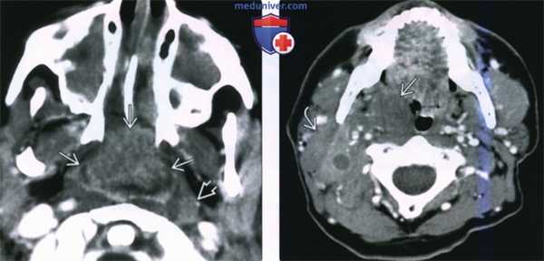 КТ, МРТ при неходжкинской лимфоме слизистого пространства глотки