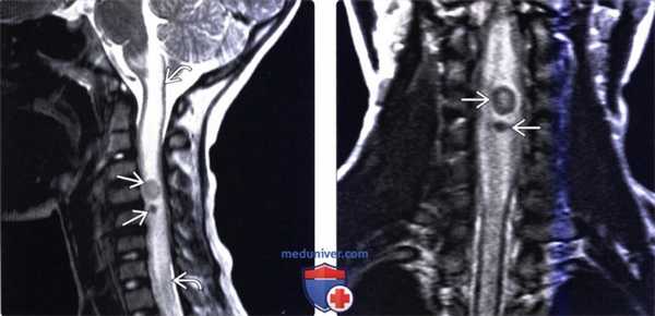 КТ, МРТ при цистицеркозе позвоночника