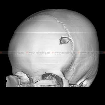 На компьютерной томографии (КТ) видно поражение черепа с классическими для эозинофильной гранулёмы скошенными краями.