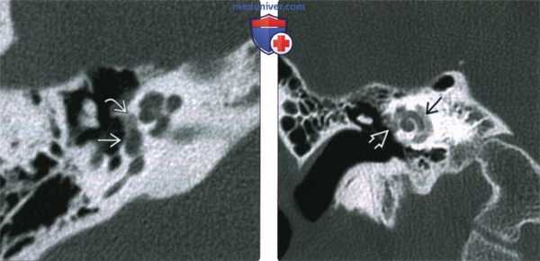 КТ, МРТ при отосклерозе
