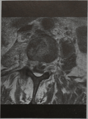 Снимки МРТ и КТ. Эпидуральный абсцесс