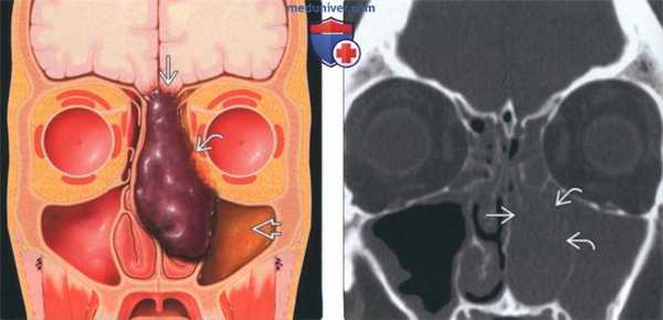 Лучевая диагностика меланомы носа и околоносовых пазух