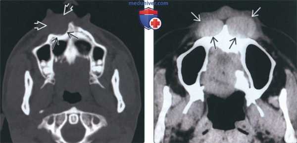 Лучевая диагностика носогубной кисты