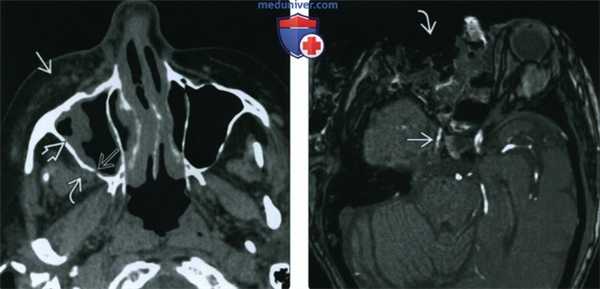 КТ, МРТ при инвазивном грибковом синусите