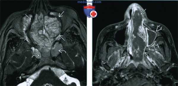 Синоназальная аденокарцинома - лучевая диагностика