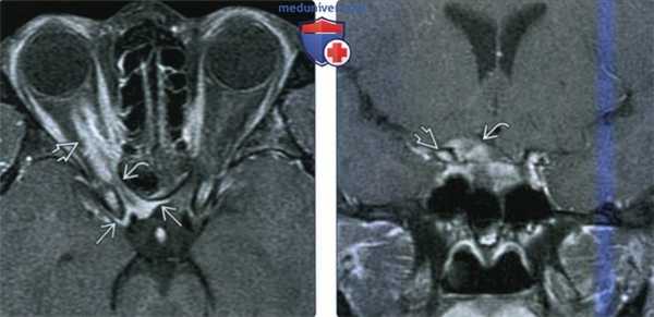 КТ, МРТ при менингиоме оболочек зрительного нерва