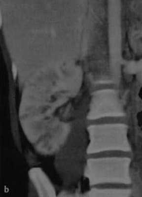 Снимки МРТ и КТ. Острый пиелонефрит