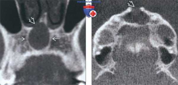 Рентгенограмма, КТ, МРТ при кисте носонебного протока