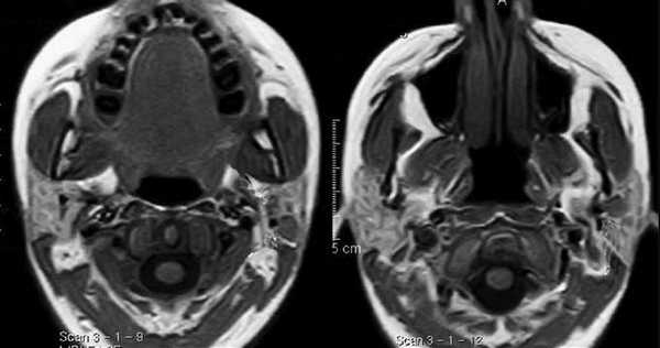 Изображение слюнных желез на МРТ