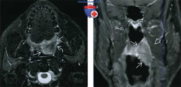 КТ, МРТ при плоскоклеточном раке небной миндалины