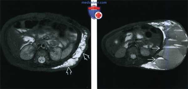 КТ, МРТ при лимфатической мальформации головы и шеи