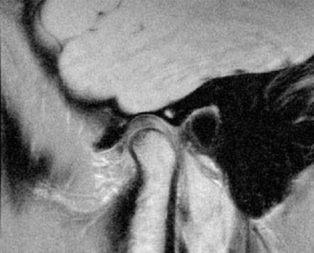 МРТ височно-нижнечелюстных суставов в диагностике заболеваний ВНЧС