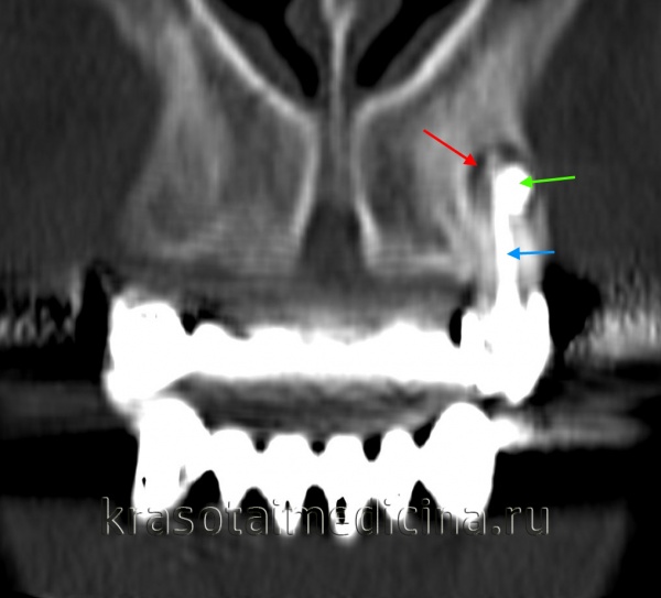 КТ челюстно-лицевой области. Радикулярная киста (красная стрелка) вблизи корня левого клыка верхней челюсти, состояние после эндодонтического лечения (синяя стрелка – филлер в корневом канале), избыток филлера за пределами верхушки зуба (зеленая стрелка).