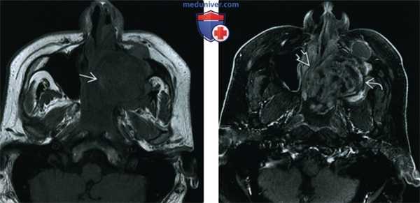 Организовавшаяся гематома пазухи, носа - лучевая диагностика
