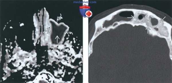 КТ, МРТ при хроническом риносинусите