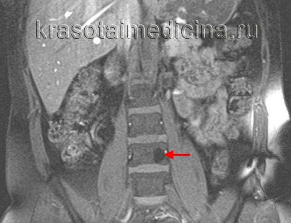 Гемангиома позвоночника