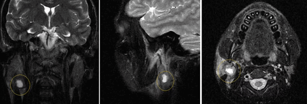 Преимущества МРТ слюнных желез