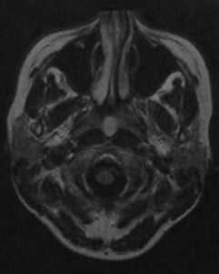 Снимки МРТ и КТ. Киста Торнвальдта - киста носоглотки