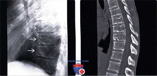 Рентгенограмма, КТ, МРТ болезни Шейерманна