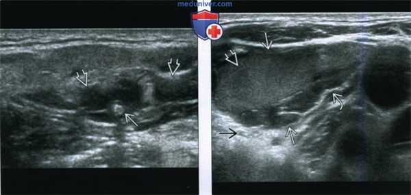 КТ, МРТ венозной мальформации головы и шеи
